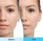 ژل ضدجوش و تنظیم‌کننده چربی پوست دیفیرین - Image 4